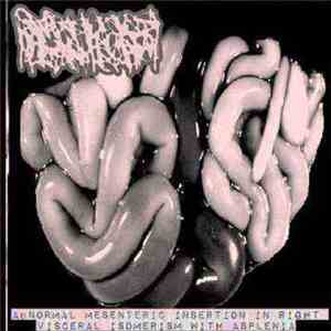 Hydrocephalus - Abnormal Mesenteric Insertion In Right Visceral Isomerism With Asplenia download flac mp3
