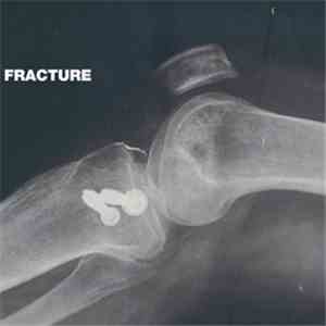 Fracture  - Fracture download flac mp3