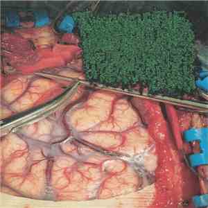 Tumors of the Hypothalamus and Neurohypophysis of Neuroepithelial Origin - Untitled download flac mp3