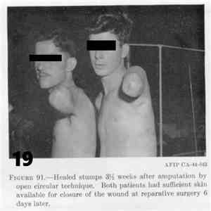 Amputee Hookers - 19 download flac mp3